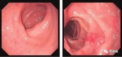 萎縮性胃炎不可怕，只要